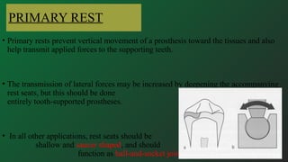 Chevron Rest Rpd REST AND REST SEAT in dentistry in rpd.pptx