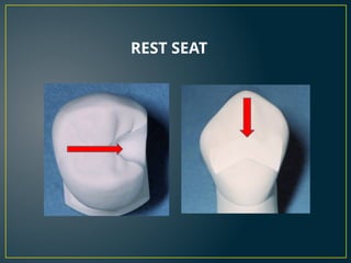 Resin Rest Rpd Rest and Rest Seat in Removable partial denture | PPTX