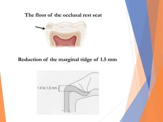 The floor of the occlusal rest seat
Reduction of the marginal ridge of 1.5 mm
 