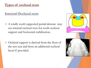 Types of occlusal rests
Internal Occlusal rests
 A totally tooth supported partial denture may
use internal occlusal rests for tooth occlusal
support and horizontal stabilization.
 Occlusal support is derived from the floor of
the rest seat and from an additional occlusal
bevel if provided.
 