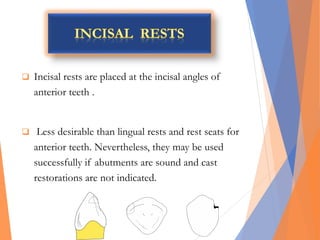  Incisal rests are placed at the incisal angles of
anterior teeth .
 Less desirable than lingual rests and rest seats for
anterior teeth. Nevertheless, they may be used
successfully if abutments are sound and cast
restorations are not indicated.
 