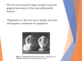 4. The rest seat created is large enough to prevent
gingival movement of the removable partial
denture.
5. Preparation of this rest seat is simple, easy, fast.
and requires a minimum of equipment.
 