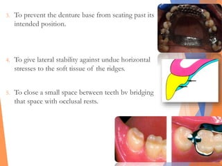3. To prevent the denture base from seating past its
intended position.
4. To give lateral stability against undue horizontal
stresses to the soft tissue of the ridges.
5. To close a small space between teeth bv bridging
that space with occlusal rests.
 