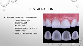 RESTAURACIÓN
• CONSISTE EN LOS SIGUIENTES PASOS:
• TÉCNICA ADHESIVA
• OPACIFICACIÓN
• MATIZACIÓN
• COLOCACIÓN DE LA CARILLA
• TERMINACIÓN
• CONTROL POSOPERATORIO
 