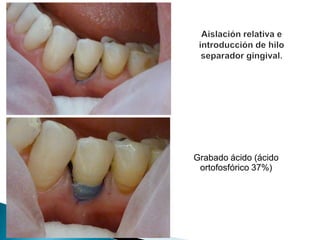 Grabado ácido (ácido
 ortofosfórico 37%)
 