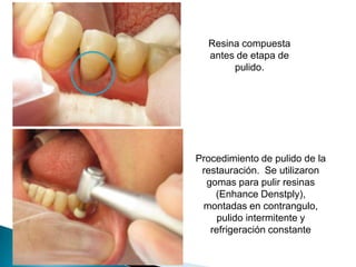 Resina compuesta
  antes de etapa de
       pulido.




Procedimiento de pulido de la
 restauración. Se utilizaron
  gomas para pulir resinas
    (Enhance Denstply),
 montadas en contrangulo,
     pulido intermitente y
   refrigeración constante
 
