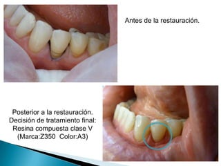 Antes de la restauración.




 Posterior a la restauración.
Decisión de tratamiento final:
 Resina compuesta clase V
  (Marca:Z350 Color:A3)
 
