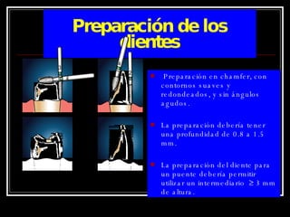 Preparación de los dientes Preparación en chamfer, con contornos suaves y redondeados, y sin ángulos agudos. La preparación debería tener una profundidad de 0.8 a 1.5 mm. La preparación del diente para un puente debería permitir utilizar un intermediario  ≥ 3 mm de altura. 