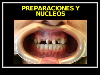 PREPARACIONES Y NUCLEOS 