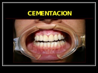 CEMENTACION 