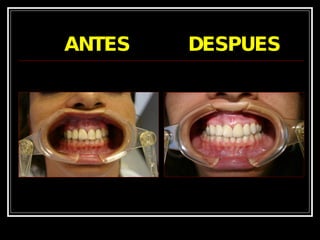 ANTES  DESPUES 