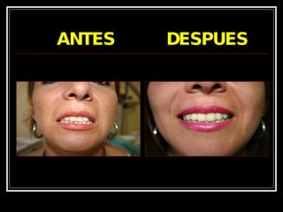 ANTES  DESPUES 