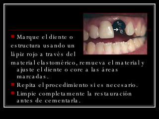 Marque el diente o  estructura usando un  lápiz rojo a través del  material elastomérico, remueva el material y ajuste el diente o core a las áreas marcadas. Repita el procedimiento si es necesario. Limpie completamente la restauración antes de cementarla. 