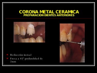 CORONA METAL CERAMICA PREPARACION DIENTES ANTERIORES Reducción incisal Fresa a 45º profundidad de 2mm 