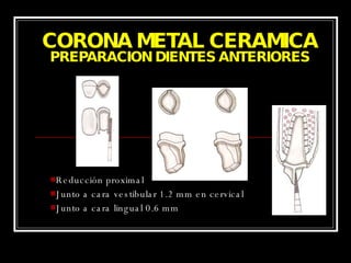 CORONA METAL CERAMICA PREPARACION DIENTES ANTERIORES Reducción proximal Junto a cara vestibular 1.2 mm en cervical Junto a cara lingual 0.6 mm 