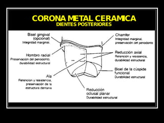 CORONA METAL CERAMICA DIENTES POSTERIORES 
