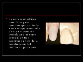 Es necesario utilizar porcelana para hombros que se funde a una temperatura más elevada y permiten completar el margen cervical en tres cocciones antes de la construcción del cuerpo de porcelana. 