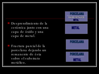 Desprendimiento de la cerámica junto con una capa de óxido y una capa de metal. Fractura parcial de la porcelana dejando un remanente de ésta sobre el substrato metálico. PORCELANA PORCELANA OXIDO METALICO METAL METAL METAL PORCELANA 