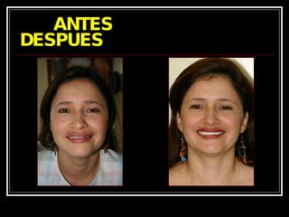ANTES  DESPUES 