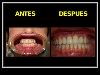 ANTES  DESPUES 