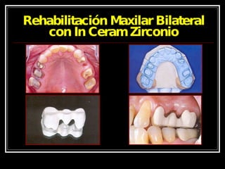 Rehabilitación Maxilar Bilateral con In Ceram Zirconio 