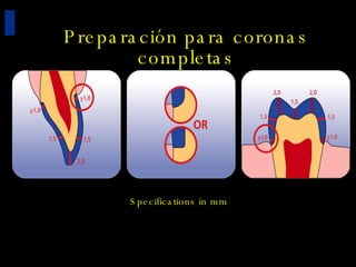 Preparación para coronas completas Specifications in mm 