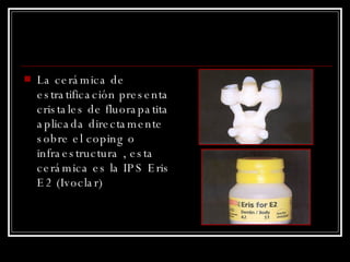 La cerámica de estratificación presenta cristales de fluorapatita aplicada directamente sobre el coping o infraestructura , esta cerámica es la IPS Eris E2 (Ivoclar) 