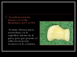 2.  Acondicionamiento interno con ácido fluorhídrico del 7 al 10% Permite obtener micro retenedores en la superficie interna de la pieza para que penetre el adhesivo/cemento resinoso en la cerámica. 