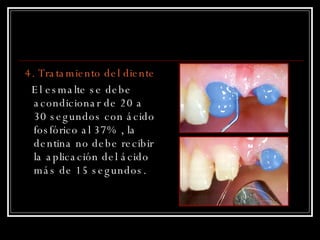 4. Tratamiento del diente El esmalte se debe acondicionar de 20 a 30 segundos con ácido fosfórico al 37% , la dentina no debe recibir la aplicación del ácido más de 15 segundos.  