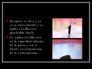 Después se lava y se seca suavemente y se aplica el adhesivo (preferible dual).  Se aplica el adhesivo en la superficie interna de la pieza y en el diente en el momento de la cementación. 