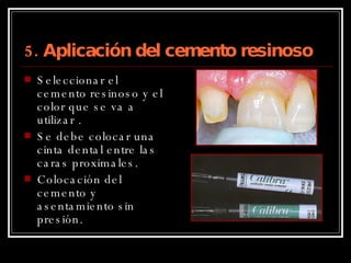 5. Aplicación del cemento resinoso Seleccionar el cemento resinoso y el color que se va a utilizar . Se debe colocar una cinta dental entre las caras proximales. Colocación del cemento y asentamiento sin presión. 