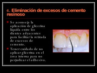 6. Eliminación de excesos de cemento resinoso Se aconseja la aplicación de glicerina líquida entre los dientes adyacentes para facilitar la retirada de excesos de cemento. Tener cuidado de no aplicar glicerina en el área interna para no perjudicar el adhesivo. 