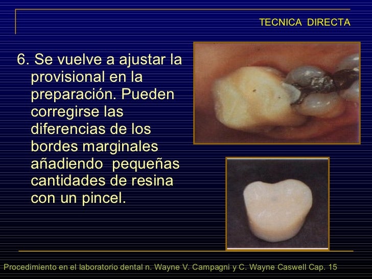 Restauraciones Provisionales