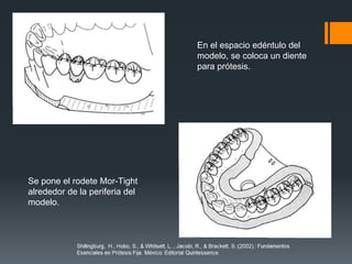 Restauraciones Provisionales En Odontologia / Protesis / Prostodoncia ...