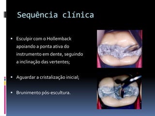 Sequência clínica

 Esculpir com o Hollemback
  apoiando a ponta ativa do
  instrumento em dente, seguindo
  a inclinação das vertentes;


 Aguardar a cristalização inicial;


 Brunimento pós-escultura.
 