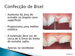  Aumento da área de
esmalte no ângulo cavo-
superficial.
 Proporciona uma melhor
estética.
 A extensão deve ser de
cerca de 0,5mm do limite
de esmalte sadio.
 Apenas na vestibular.
Terra, G.
 