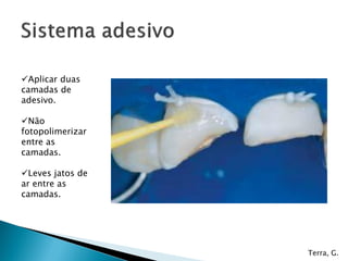 Aplicar duas
camadas de
adesivo.
Não
fotopolimerizar
entre as
camadas.
Leves jatos de
ar entre as
camadas.
Terra, G.
 