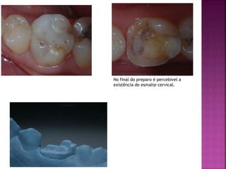 No final do preparo é percebível a
existência de esmalte cervical.
 