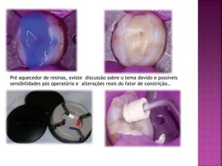 Pré aquecedor de resinas, existe discussão sobre o tema devido e possiveis
sensibilidades pós operatória e alterações reais do fator de constrição..
 