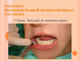 CASO CLÍNICO:
RESTAURAÇÃO CLASSE III NOS DENTES 42 (MESIAL)
E 41 (DISTAL)
1° Passo: Aplicação do anestésico tópico
 