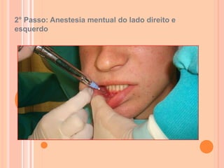2° Passo: Anestesia mentual do lado direito e
esquerdo
 