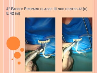 4° PASSO: PREPARO CLASSE III NOS DENTES 41(D)
E 42 (M)
 