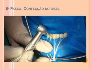 5º PASSO: CONFECÇÃO DO BISEL
 