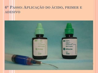 6° PASSO: APLICAÇÃO DO ÁCIDO, PRIMER E
ADESIVO
 