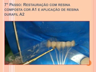 7° PASSO: RESTAURAÇÃO COM RESINA
COMPOSTA COR A1 E APLICAÇÃO DE RESINA
DURAFIL A2
 