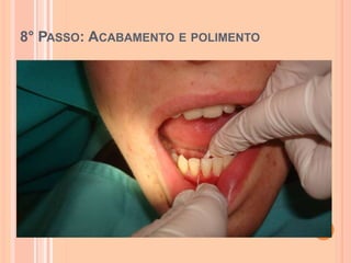 8° PASSO: ACABAMENTO E POLIMENTO
 