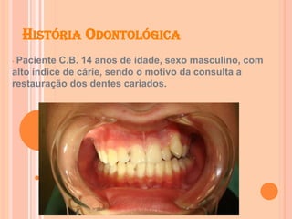 HISTÓRIA ODONTOLÓGICA
• Paciente C.B. 14 anos de idade, sexo masculino, com
alto índice de cárie, sendo o motivo da consulta a
restauração dos dentes cariados.
 