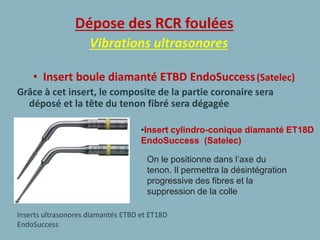 Dépose des RCR foulées
Vibrations ultrasonores
• Insert boule diamanté ETBD EndoSuccess(Satelec)
Grâce à cet insert, le composite de la partie coronaire sera
déposé et la tête du tenon fibré sera dégagée
Inserts ultrasonores diamantés ETBD et ET18D
EndoSuccess
On le positionne dans l’axe du
tenon. Il permettra la désintégration
progressive des fibres et la
suppression de la colle
•Insert cylindro-conique diamanté ET18D
EndoSuccess (Satelec)
 