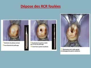 Dépose des RCR foulées
 