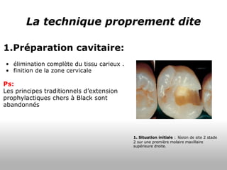 La technique proprement dite 1.Préparation cavitaire:   élimination complète du tissu carieux . finition de la zone cervicale  Ps: Les principes traditionnels d’extension prophylactiques chers à Black sont abandonnés 1. Situation initiale  :   lésion de site 2 stade 2 sur une première molaire maxillaire supérieure droite. 